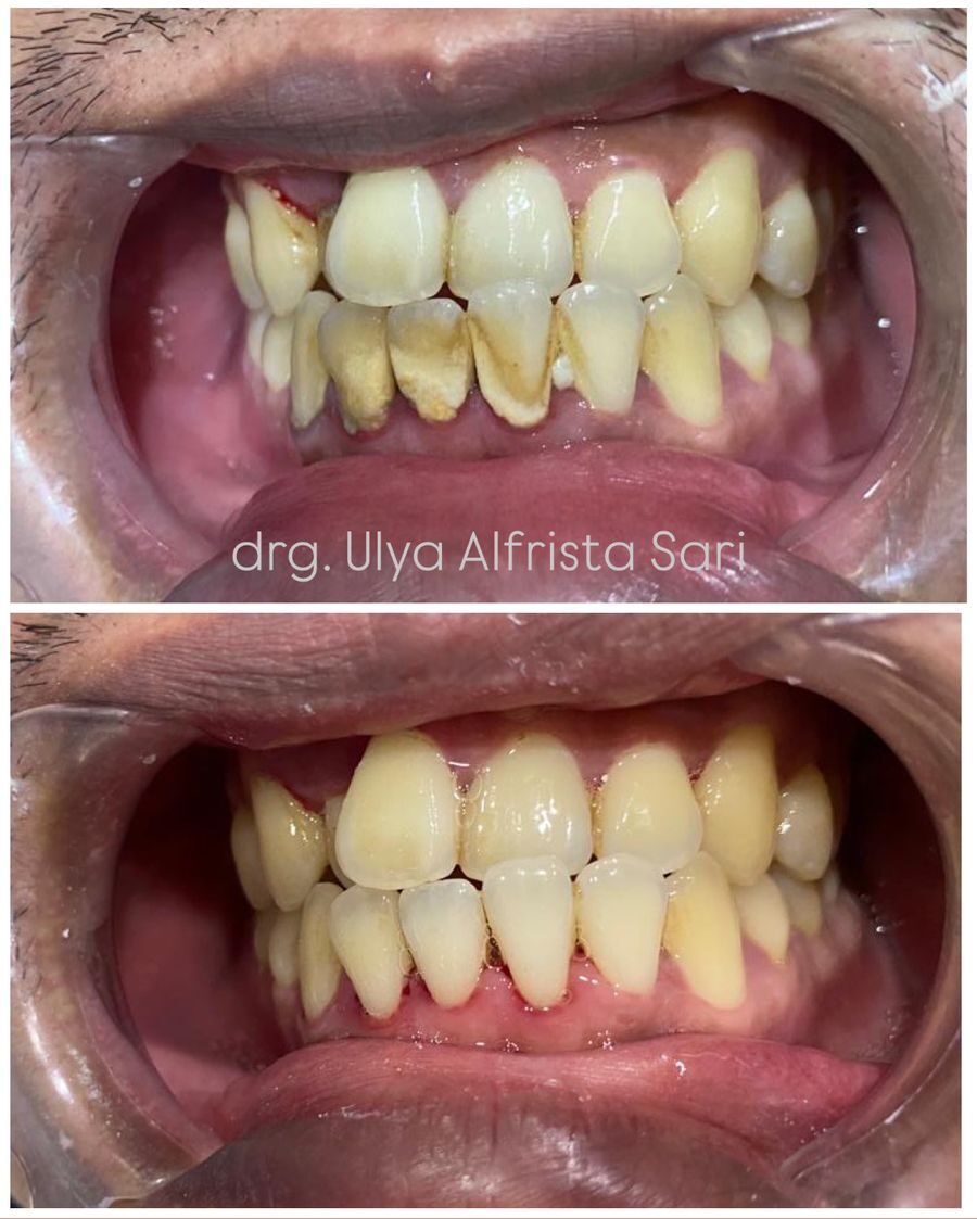 Dampak Perawatan Gigi Dan Mulut Terhadap Kesehatan